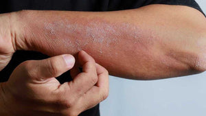 Managing Eczema and Dermatitis: Audaja’s Essential Skincare Solutions