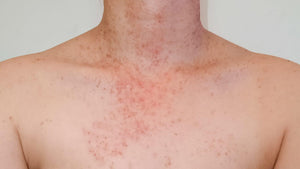 Combatting Folliculitis: Achieve Clearer, Healthier Skin with Audaja