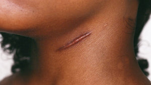 Keloids and Hypertrophic Scars an Effective Solutions for Smoother Skin