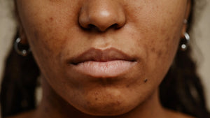 Effective Solutions for Tackling Hyperpigmentation