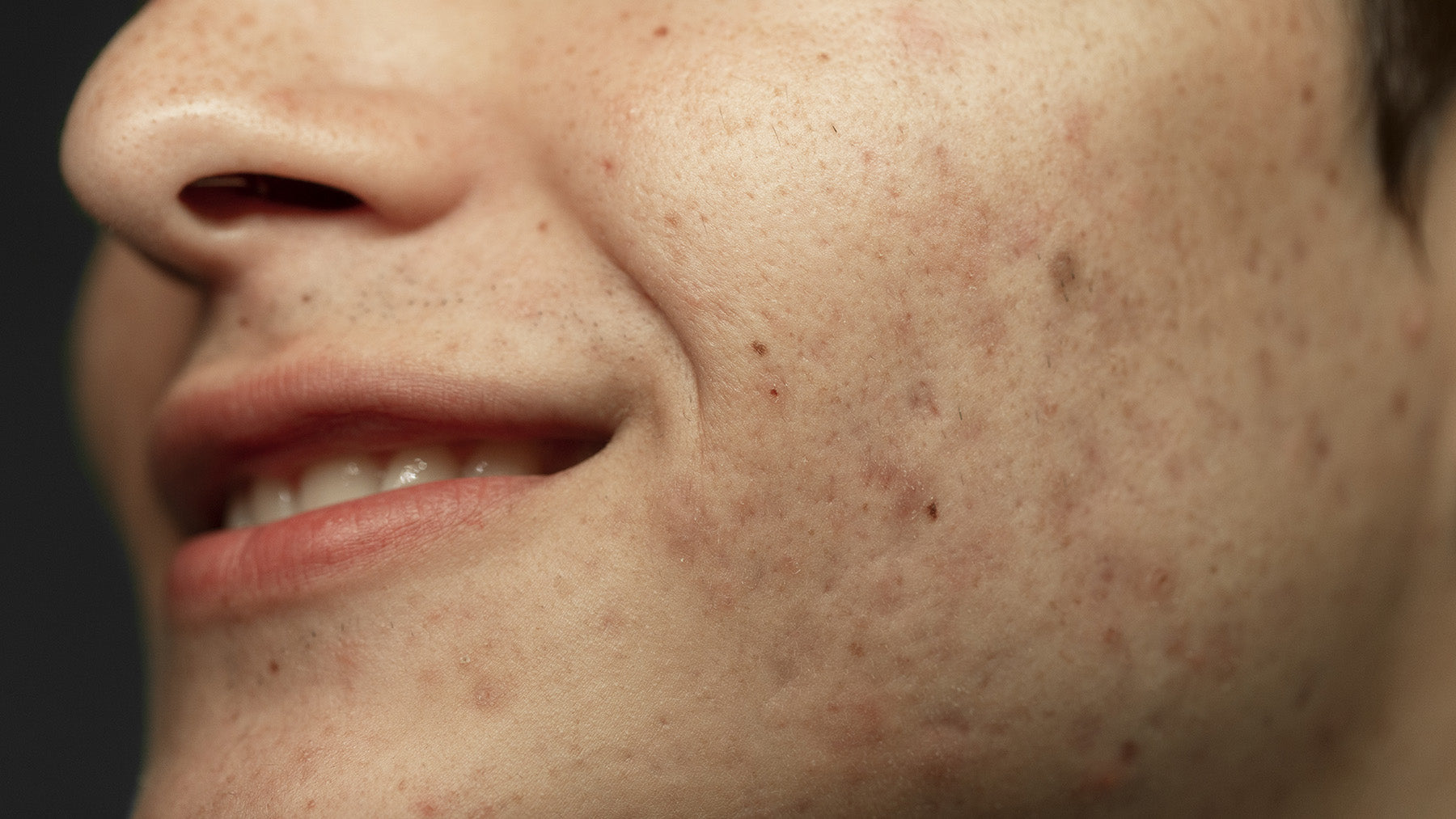 Hyperpigmentation & Dark Spots: Why They Happen and How to Finally Fade Them