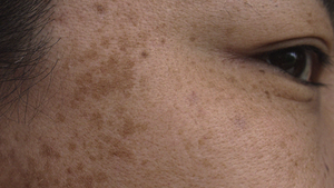Hyperpigmentation one of the most common concern