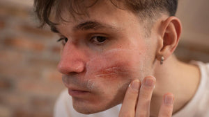 Irritated Skin? Unveiling the Power of Soothify Serum